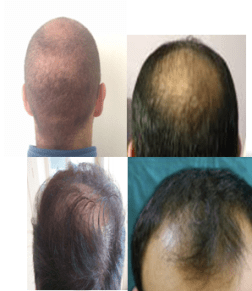 chierica-trapianti-capelli