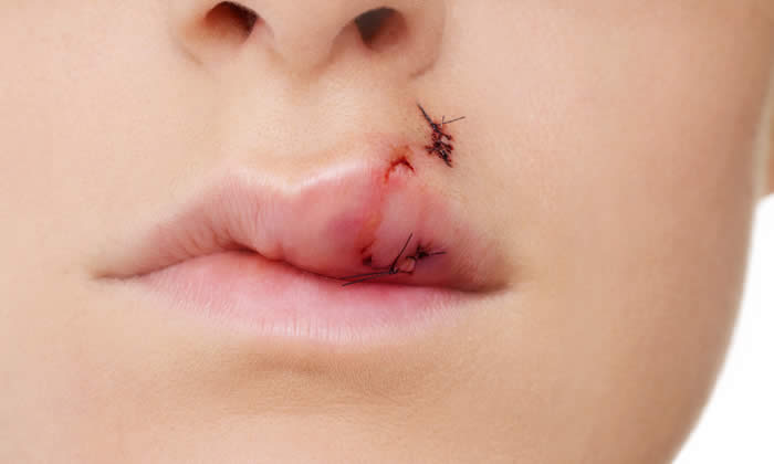 filler-permanenti-effetti-collaterali